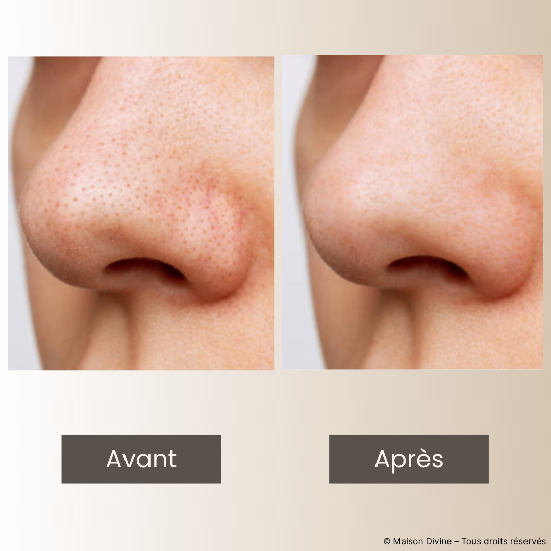 Patchs Nez Hydrocolloïdes